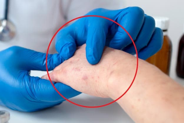 blog vital: Diabetes y piel ¿cómo afecta este órgano?