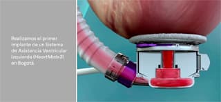 sistema de asistencia ventricular